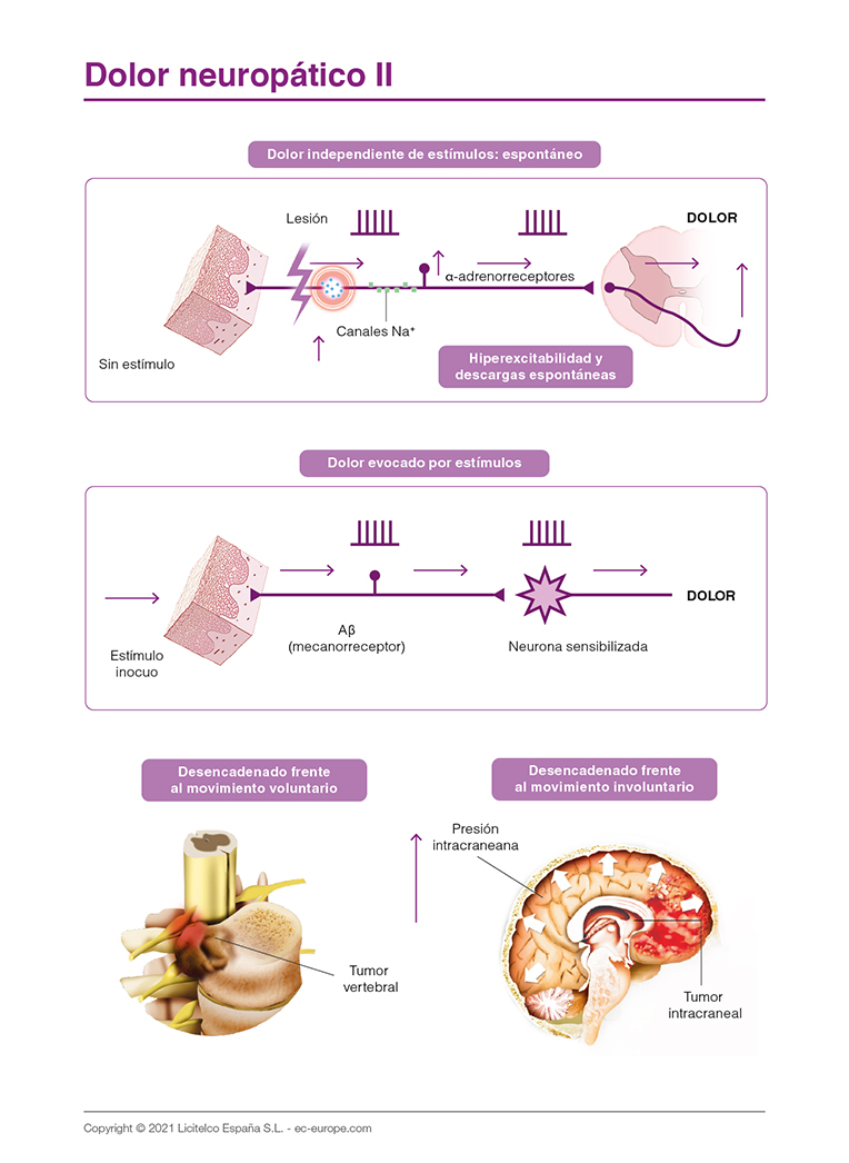 dolor neuropático ii