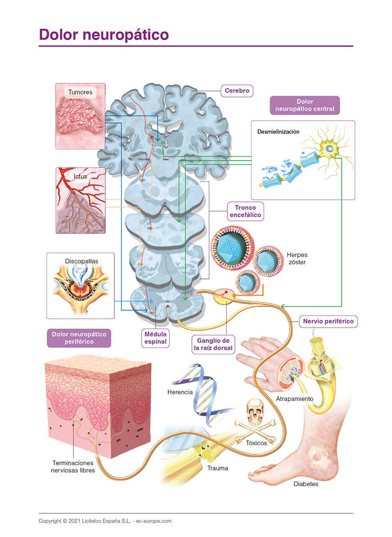 dolor neuropático