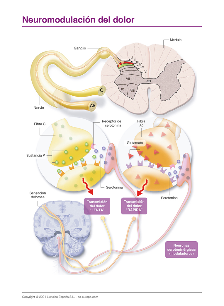 neuromodulación del dolor