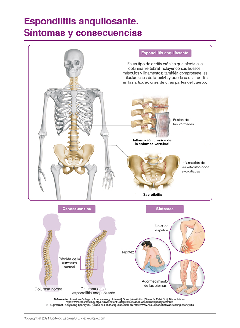  Espondilitis anquilosante. Síntomas y consecuencias
