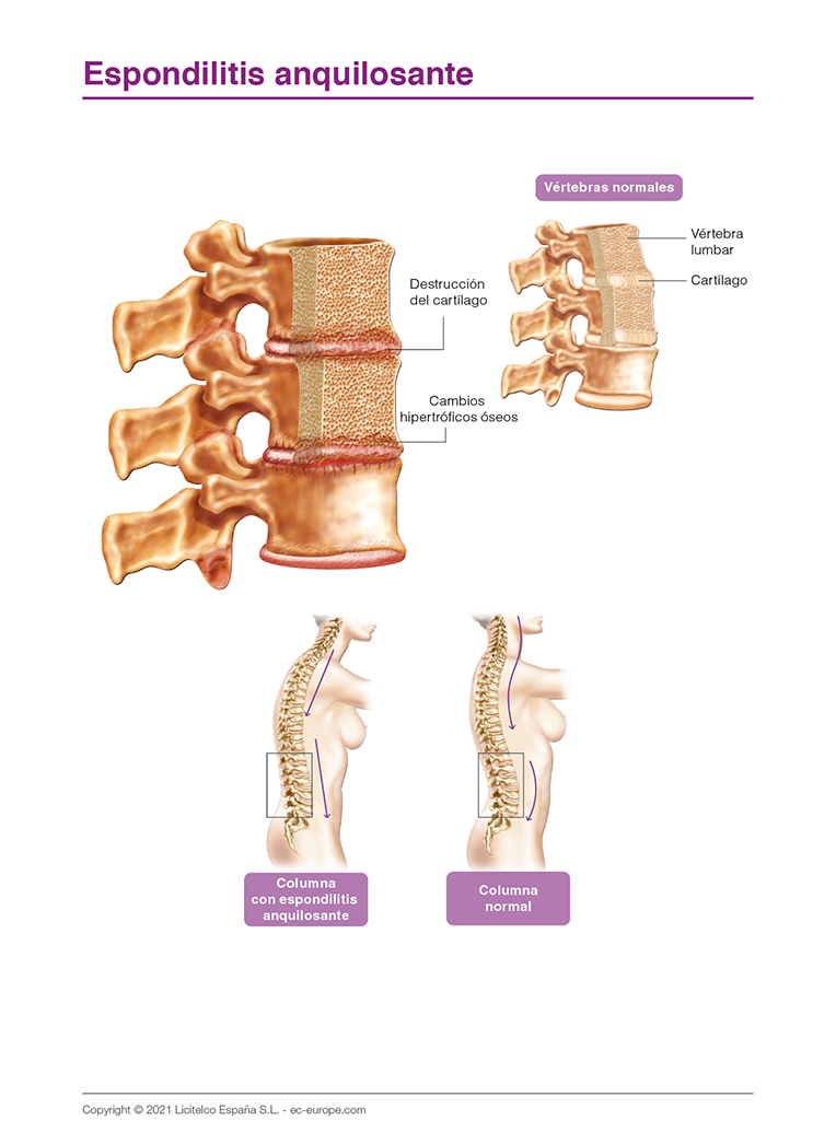 espondilitis anquilosante