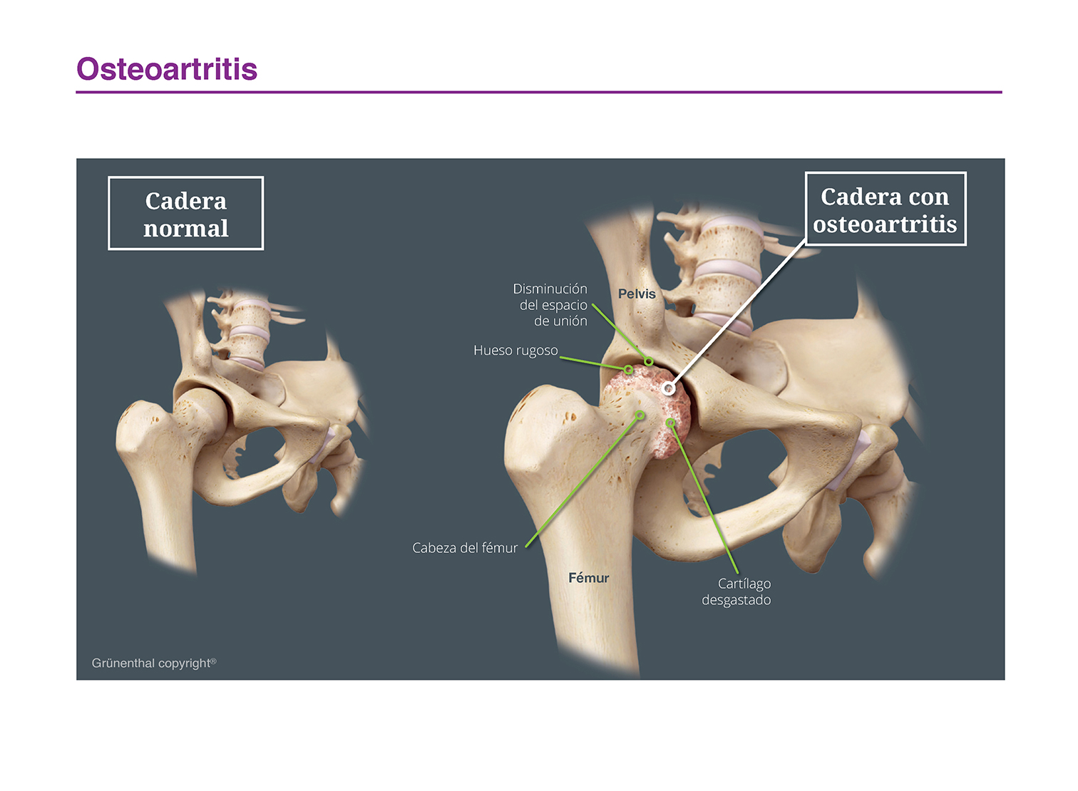 osteoartritis
