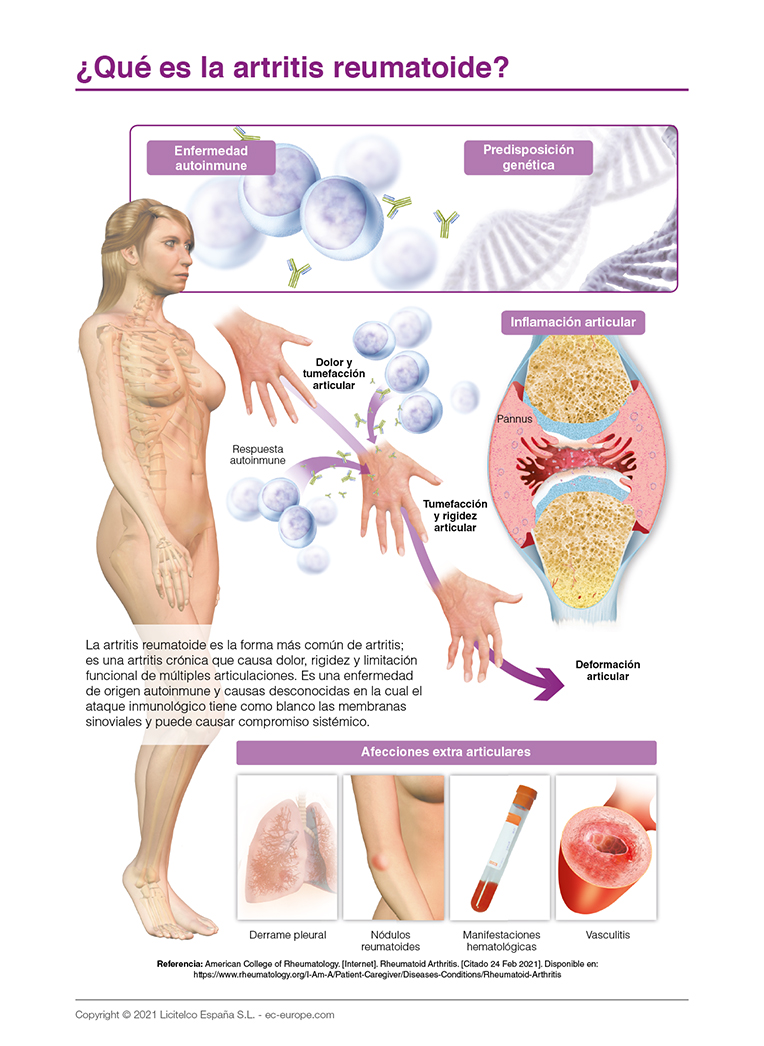 ¿Qué es la artritis reumatoide?