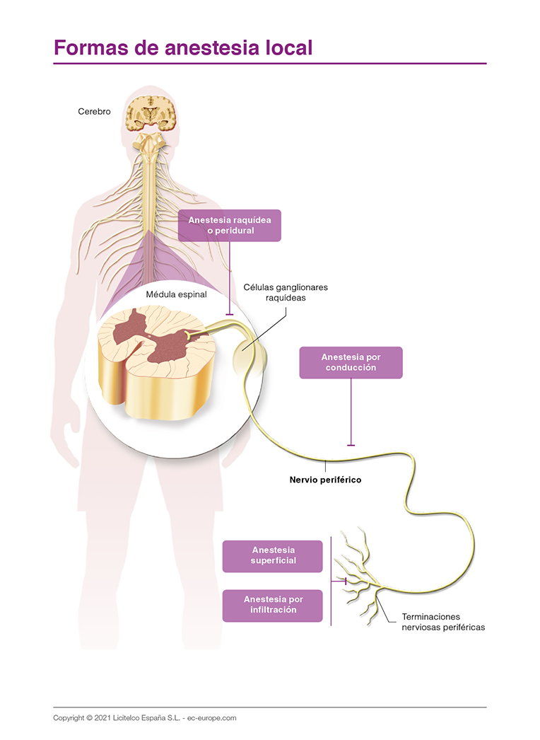 formas de anestesia local