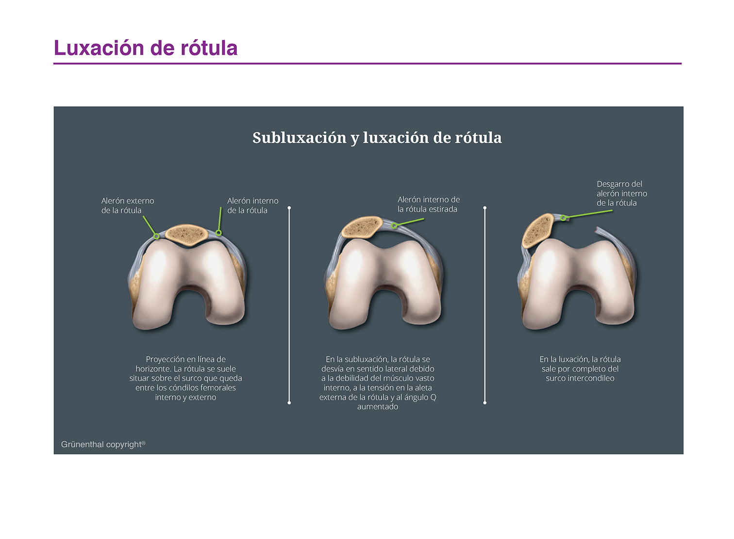 luxación de rótula
