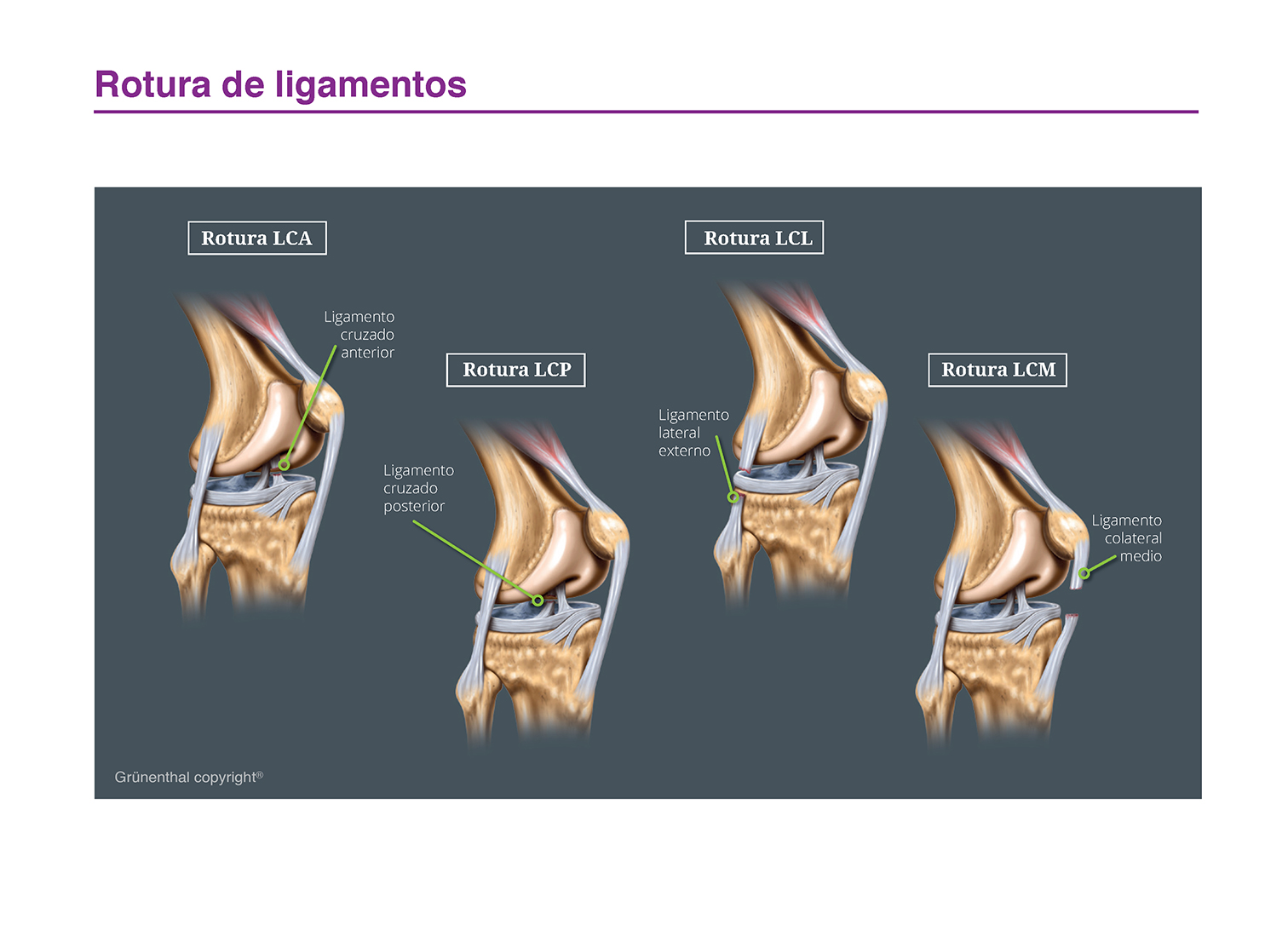 rotura de ligamentos