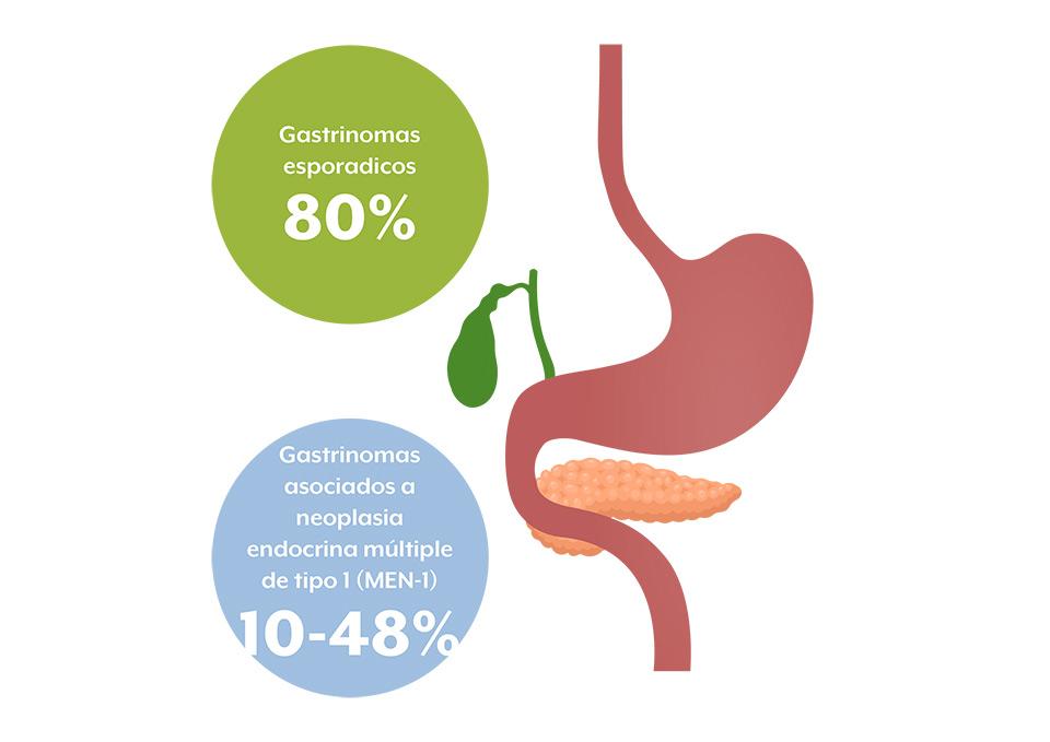 Causas Síndrome Zollinger Ellison