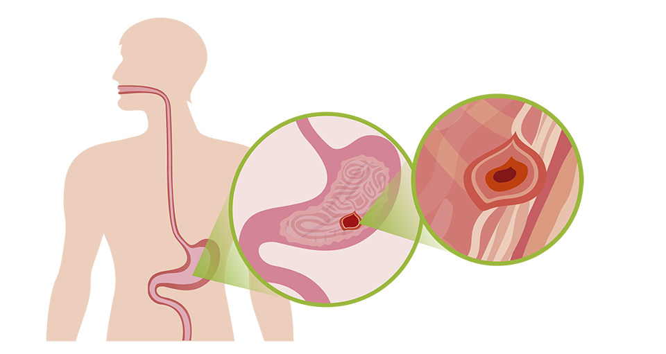 Síntomas Síndrome Zollinger Ellison