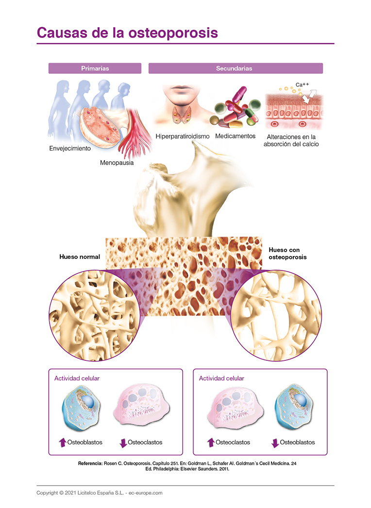 causas de la osteoporosis