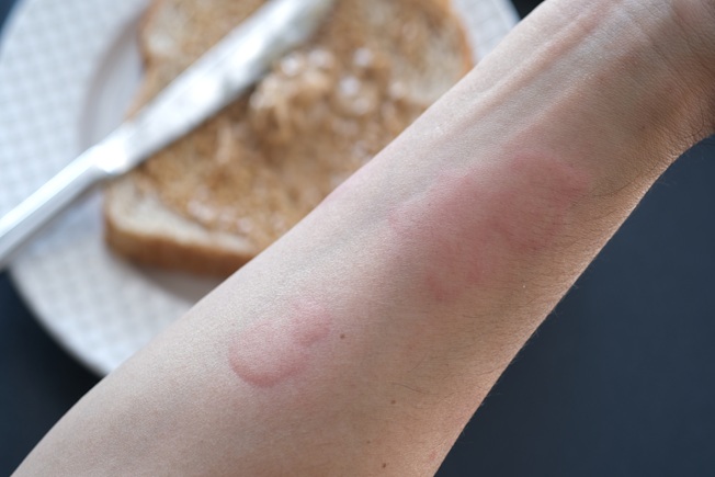 Welts on arm from urticaria