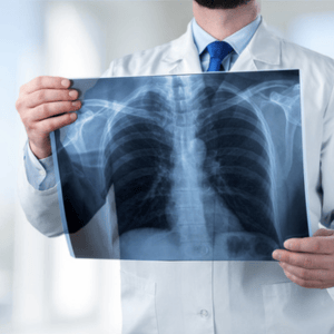 Doctor in a white coat holding up a chest X-ray scan showing the ribcage and spine.