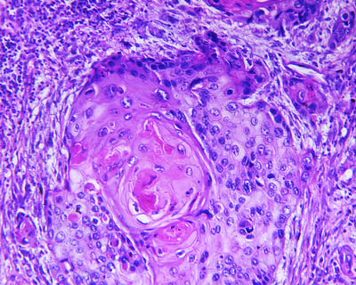 squamous cell carcinoma panorama