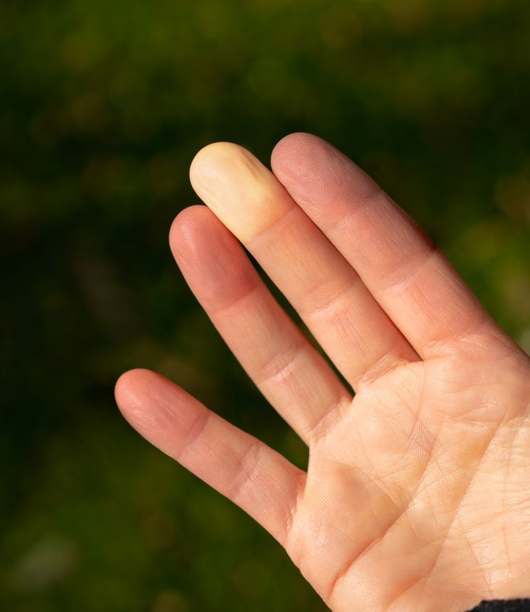 Hand-Arm Vibration Syndrome (HAVS): Is an increased awareness linked with an increase in reporting of new HAVS cases?