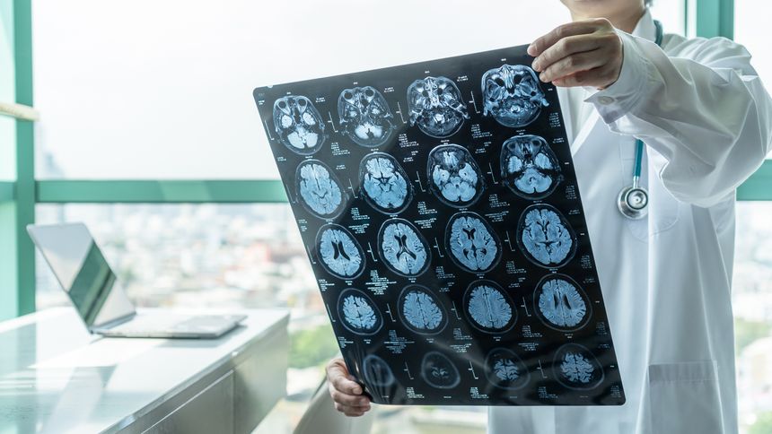 Treating benign paroxysmal positional vertigo (BPPV) in brain injury cases