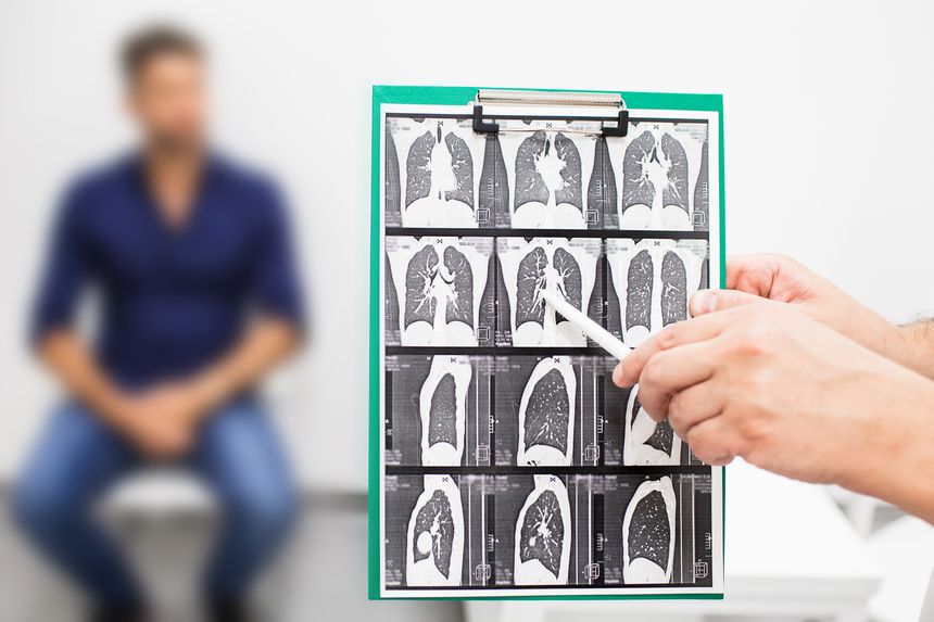 What is pulmonary fibrosis? Expert lawyer sets out key information