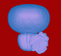 Oncology Solid Tumor