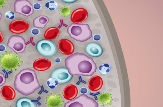 Infection risk in multiple myeloma