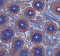 Pulmonary Hypertension