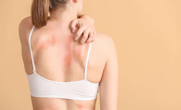 alergia piel