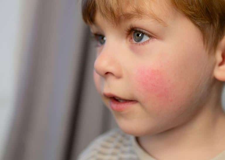 brote piel atopica niños