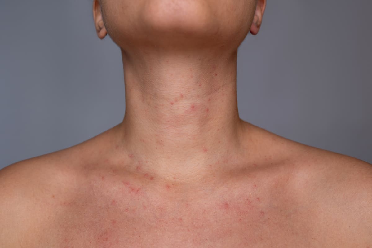 irritacion de la piel por sudor