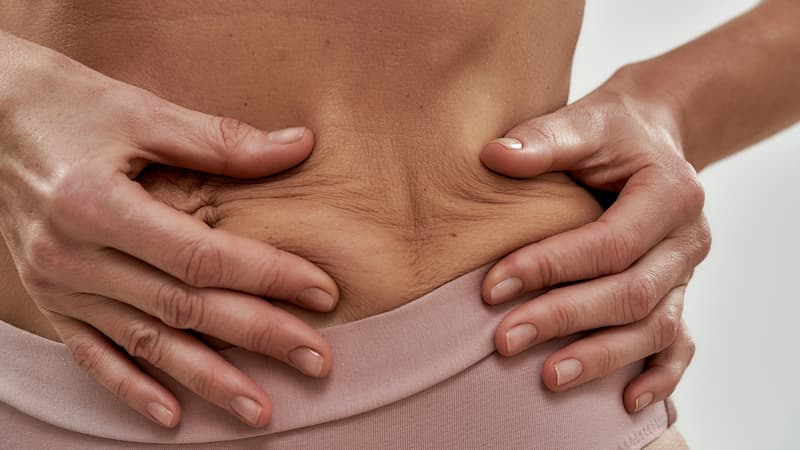 piel flacida abdomen
