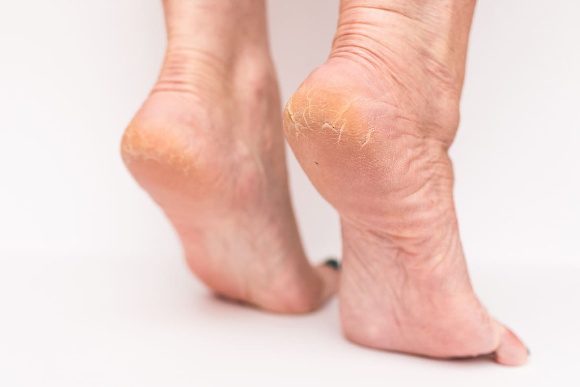 piel extremadamente seca