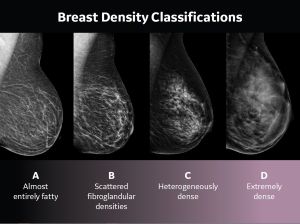 Breast density classifications 300x224