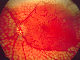 Image shows the damage to the retina from abnormal blood vessels that develop as a result of diabetic retinopathy.