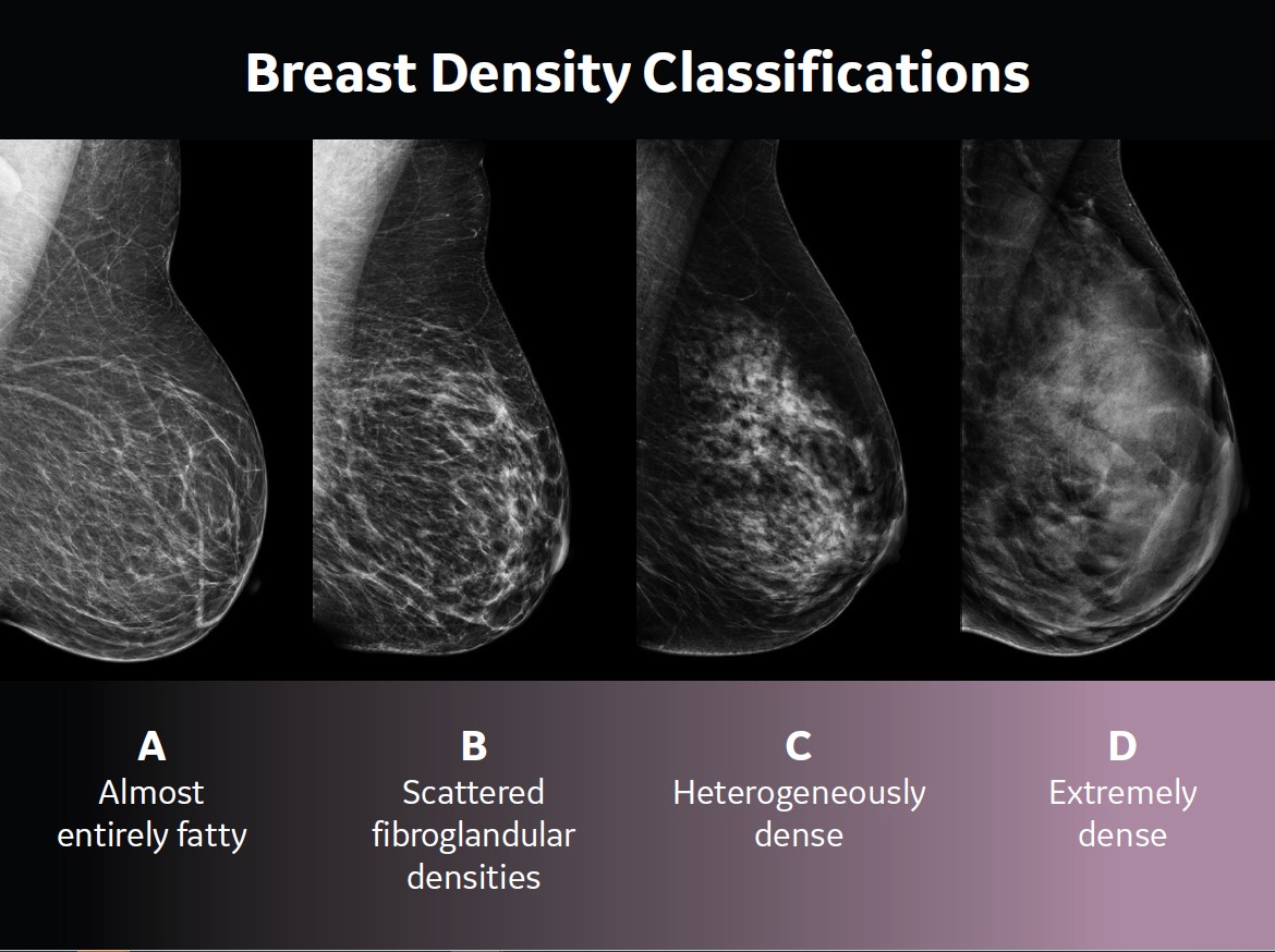 Breast density classifications show how dense breast tissue changes mammography images