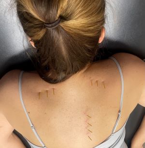 woman with dry needling on back
