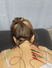 Rachel Ethridge dry needling 2