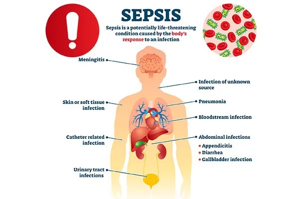 chart showing how sepsis affects the body