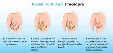 breast reduction procedure