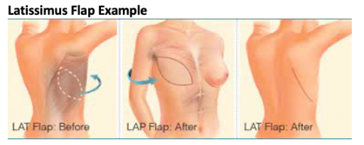 Illustration of a lat flap before and after
