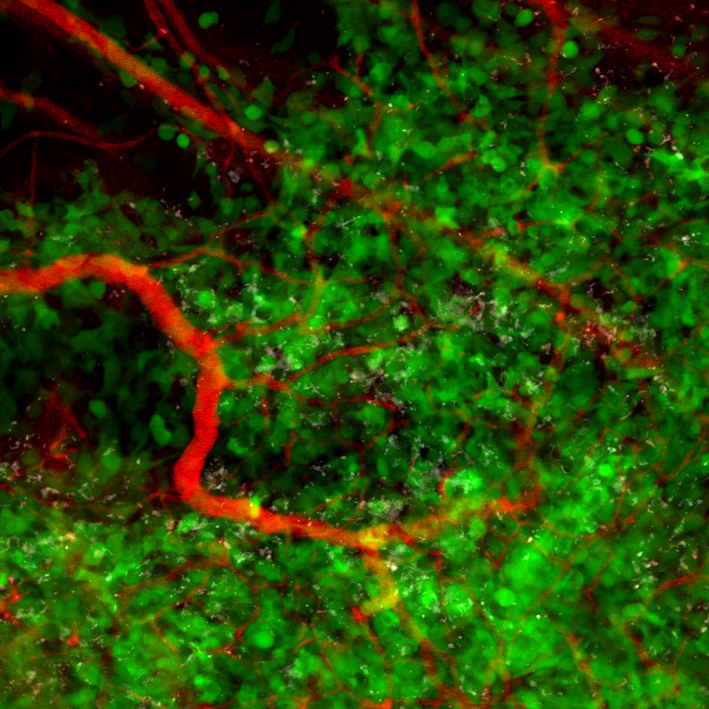 A microscope image shows cancer cells, blood vessels and immune cells.