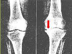 image of knee being x rayed