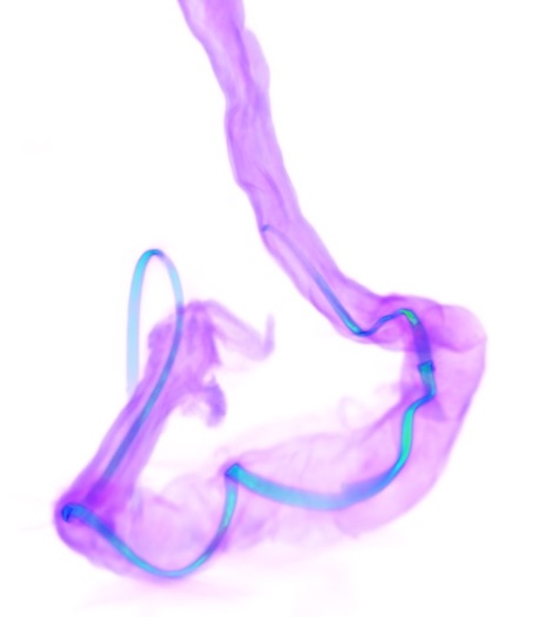 An X-ray CT image shows a NeuroString (blue) sensor implanted in a colon (purple). Credit: Li et al. Nature.
