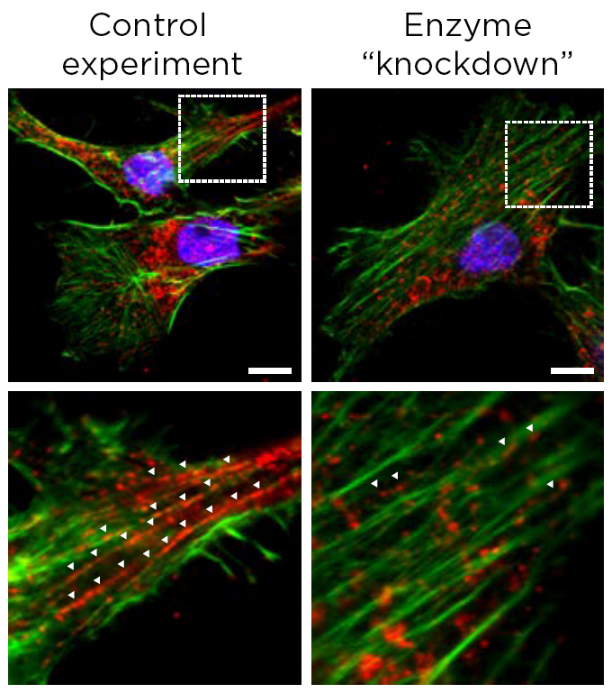 These fluorescent micrographs from an experiment help illustrate how cascading effects can lead to cancer cells metastasizing. On the left, a control sample from a mouse cancer cell line (the cell nucleus is shown in blue) expresses a high level of the PHGDH enzyme shown in green as well as a different enzyme that PHGDH interacts with, shown in red. On the right, researchers have reduced or knocked down the level of PHGDH, which in turn decreases the enzyme shown in red. Images on the bottom row show a zoomed-view of the boxed areas in the upper row to magnify the results. Credit: Rossi et al., Nature