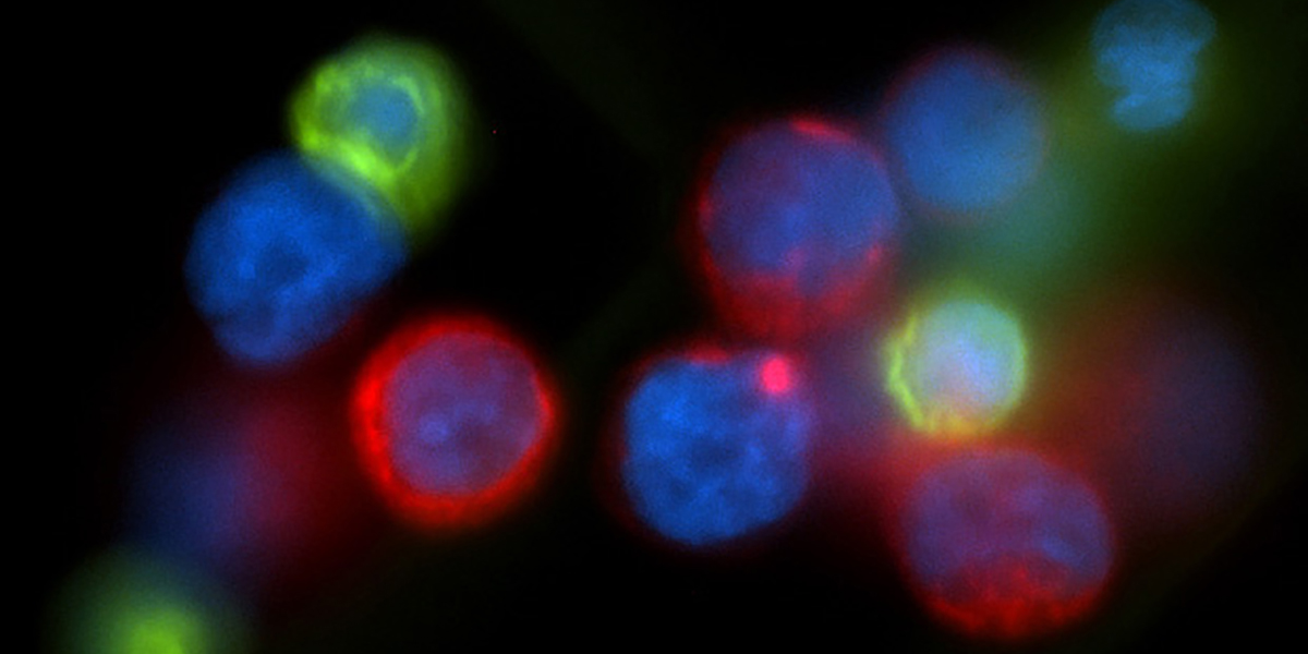 A micrograph shows cancer cells (red) found circulating in the blood of a breast cancer patient. Credit: National Cancer Institute/USC Norris Comprehensive Cancer Center/Min Yu