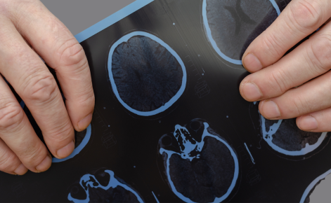 Hands hold copies of brain scans.