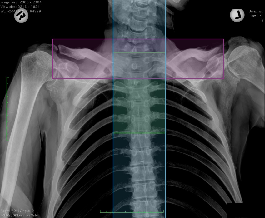 Radiograph showing the four regions of interest (ROIs) evaluated in this research, thoracic vertebrae 1-5 (green), entire vertebral column (blue), and clavicles (pink), and the overall radiograph.