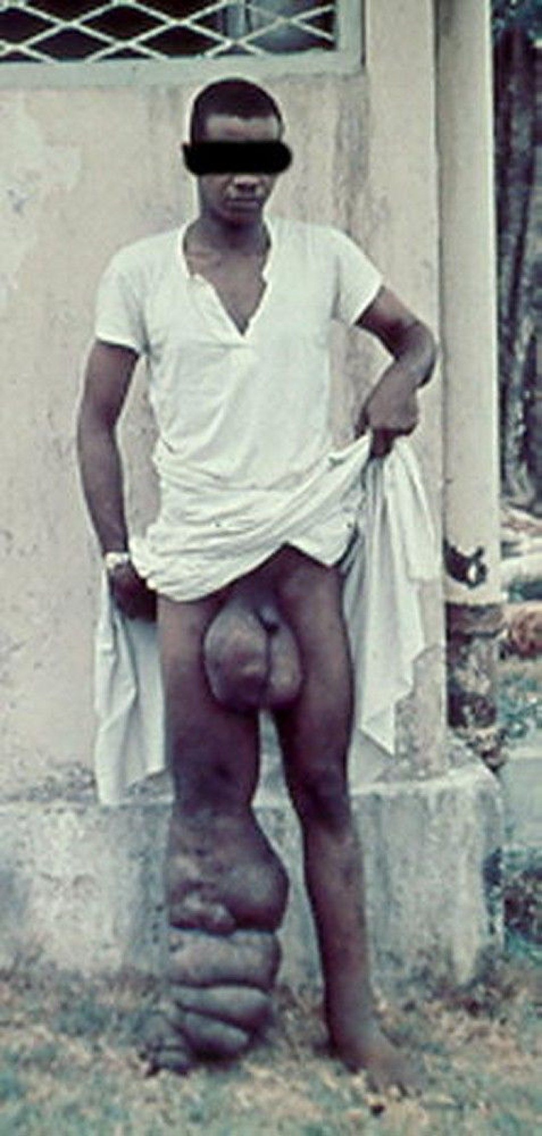 Elephantiasis in Lymphatic Filariasis