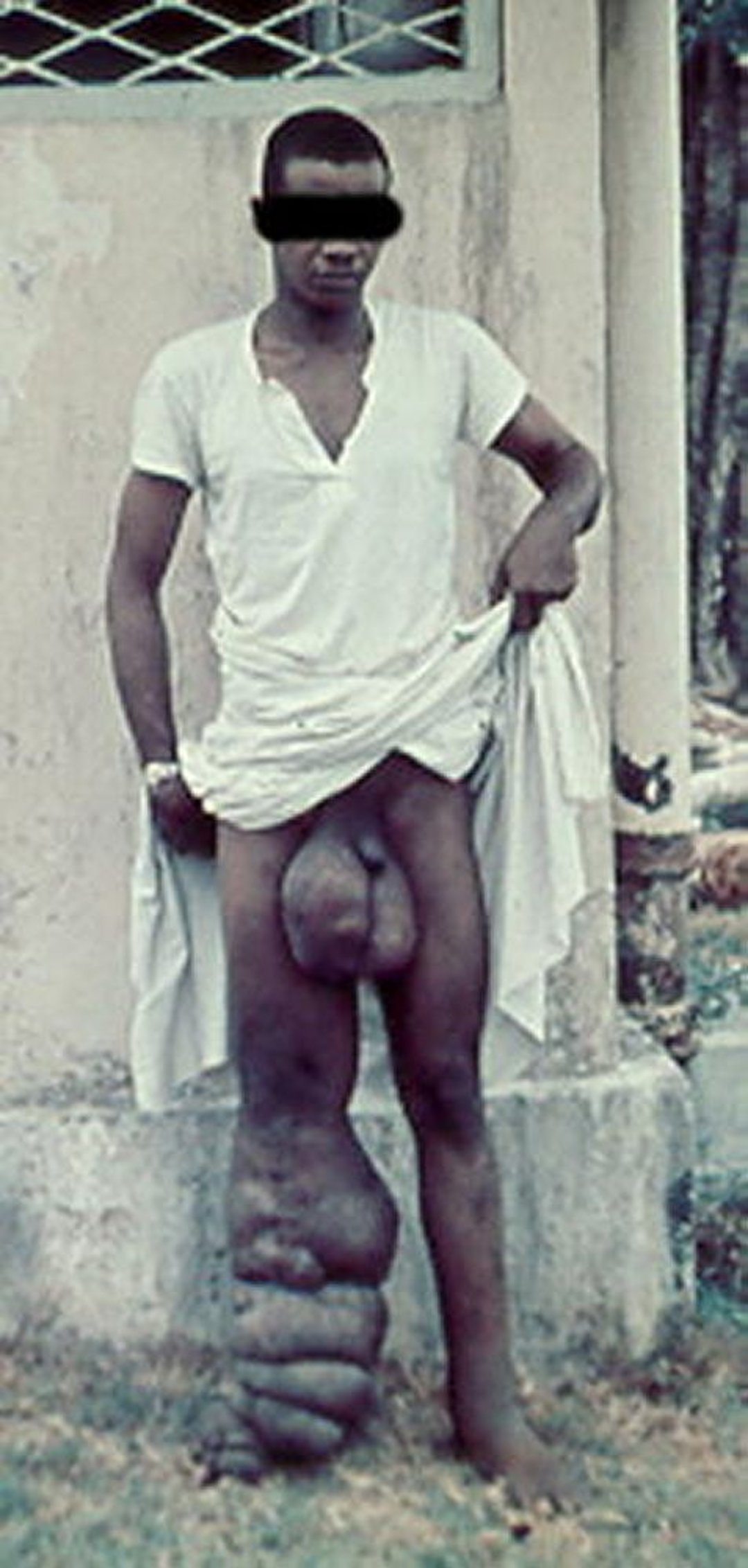 Elefantiasis en la filariasis linfática