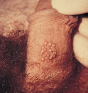 Herpes genital en el pene