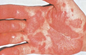 Keratoderma blennorrhagicum an der Handfläche