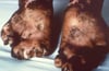 Severe Effects of Leprosy Affecting the Hands