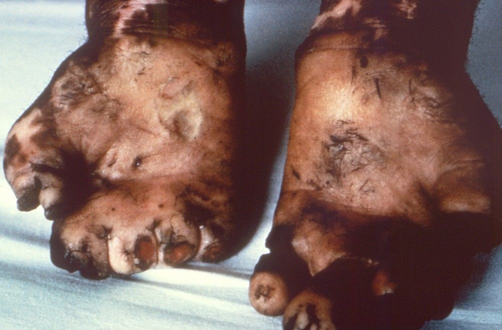 Severe Effects of Leprosy Affecting the Hands