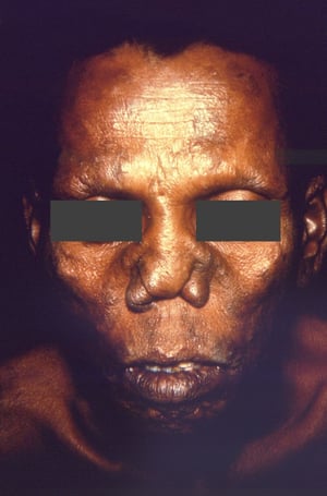 Efectos graves de la lepra que afectan a la nariz