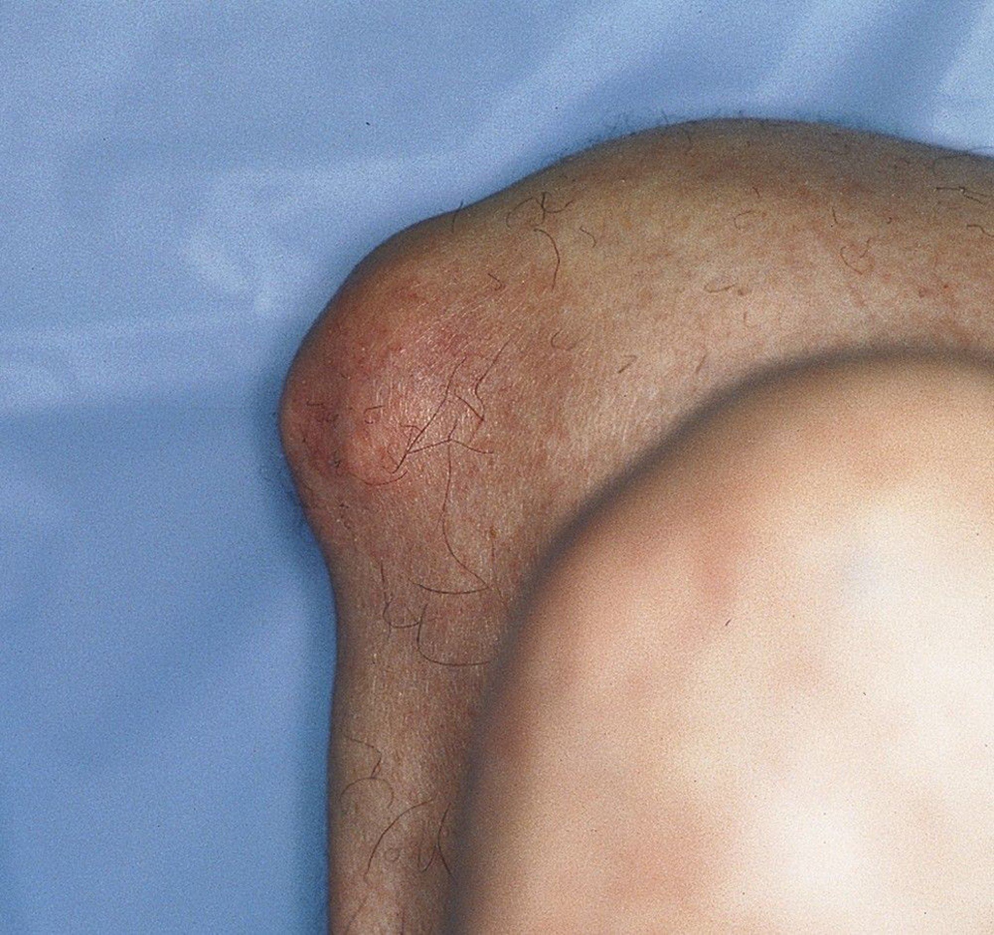 Tophi in the Knee